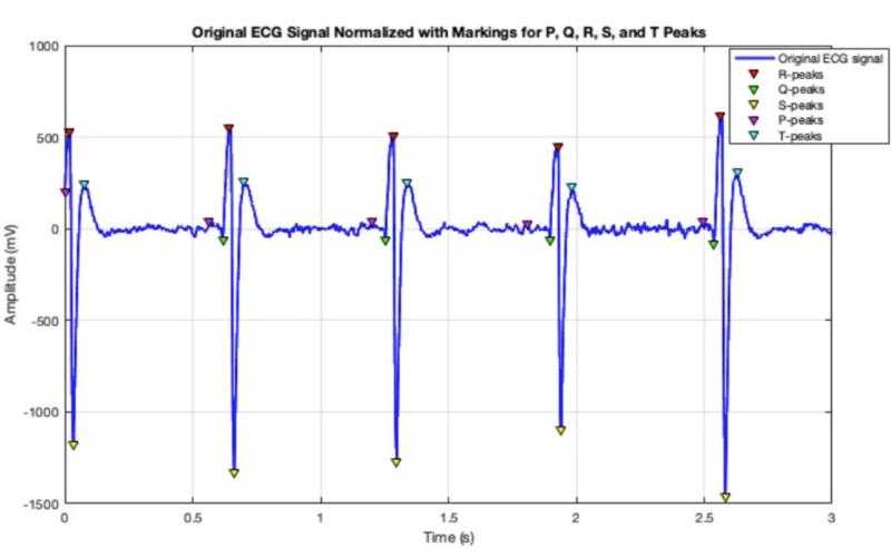Annotated ECG signal with identified PQRST features